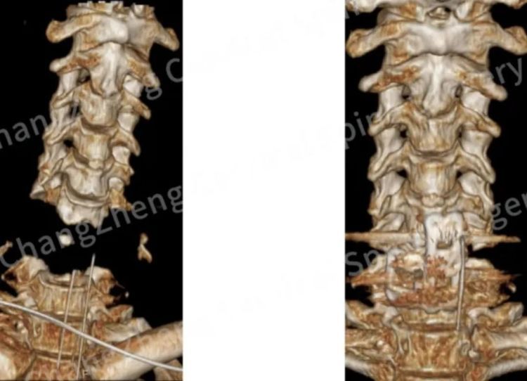 “身首离断”患者被救回！中国医生挑战“不可能”