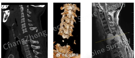 身首离断患者被中国医生救回点赞！致敬医者仁心！