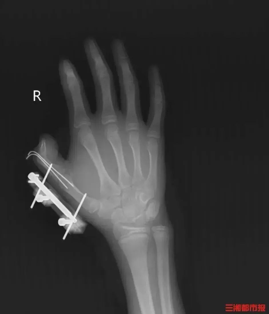 你家冰箱里可能也有！14岁男孩差点儿被它炸断拇指→