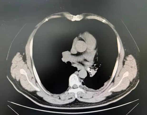 反复肺炎、咳嗽、呼吸困难！男子被折磨数十年，“元凶”竟是…