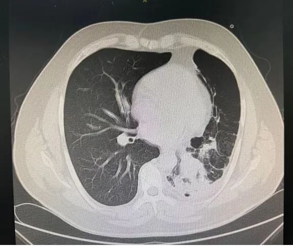 反复肺炎、咳嗽、呼吸困难！男子被折磨数十年，“元凶”竟是…