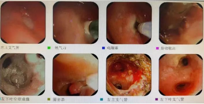 反复肺炎、咳嗽、呼吸困难！男子被折磨数十年，“元凶”竟是…