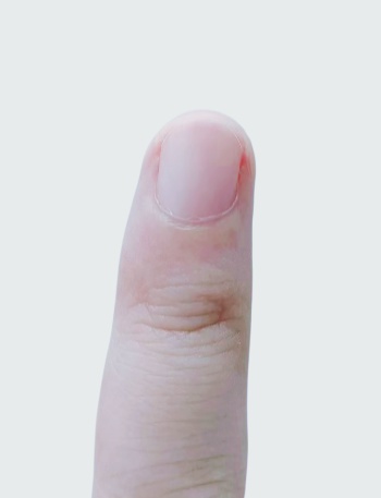紧急提醒：指甲出现这个变化，可能是癌变！别不当回事！