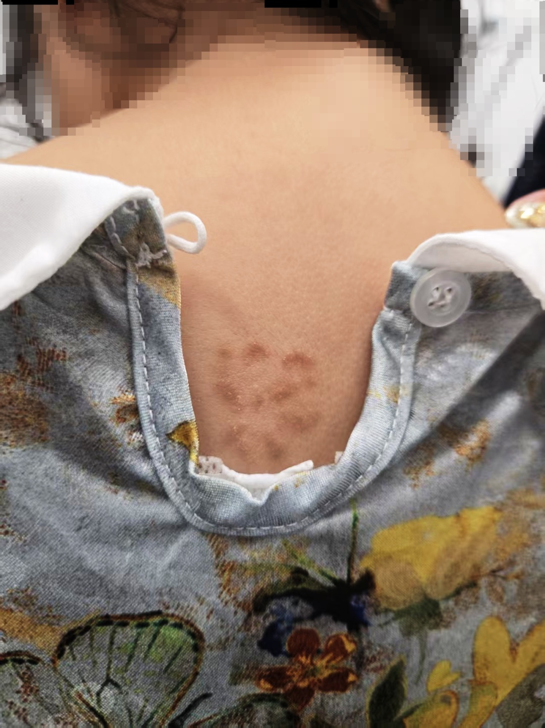 浙江5岁女童背上长出“梅花”！起因竟是家中团宠
