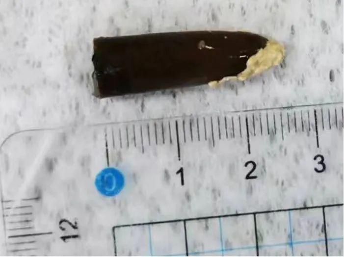 反复肺炎、咳嗽、呼吸困难！男子被折磨数十年，“元凶”竟是…