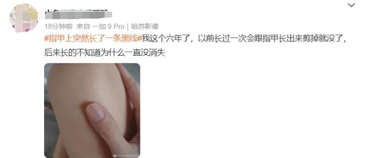 紧急提醒：指甲出现这个变化，可能是癌变！别不当回事！