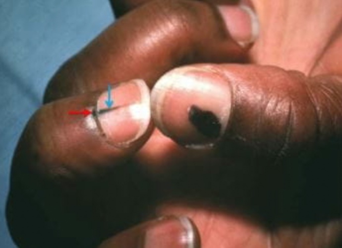 紧急提醒：指甲出现这个变化，可能是癌变！别不当回事！