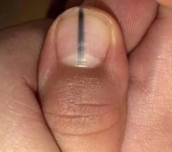 紧急提醒：指甲出现这个变化，可能是癌变！别不当回事！