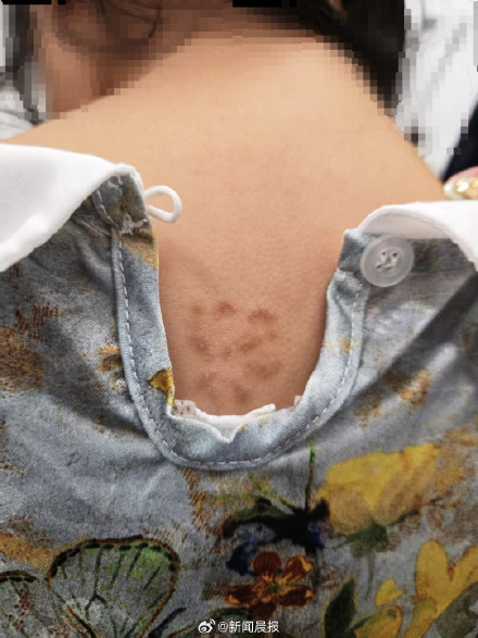 5岁女童背上长出"梅花"！有传染性！起因竟是家中"团宠"...