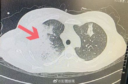 感染鹦鹉热发烧一周 37岁孕妇手养鹦鹉高烧成白肺 感染鹦鹉热发烧一周 37岁孕妇手养鹦鹉高烧成白肺