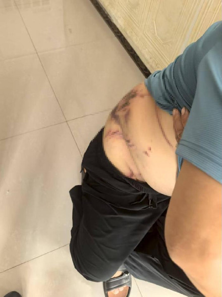 湖北鹤峰一村民被猛兽袭击腰背受伤