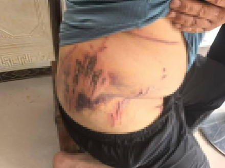 湖北鹤峰一村民被猛兽袭击腰背受伤