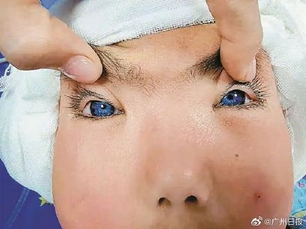 深圳7岁女孩天生蓝眼睛，确诊罕见病Waardenburg综合征