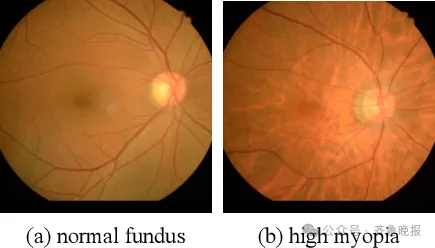 知名女演员自曝“近视700度”，需长期佩戴隐形眼镜！重要提醒：近视别超过这个度数，严重可致失明