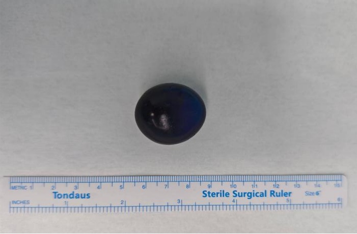 幼童紧急送医，需开腹手术！“元凶”很多家长常买，赶紧扔！