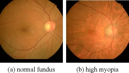 演员杨超越自曝近视700度,高度近视要警惕了 演员杨超越自曝近视700度,高度近视要警惕了