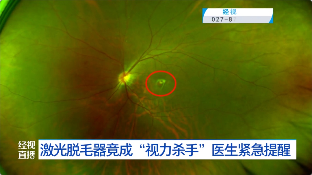 使用时操作不当，女子眼睛“黄斑区灼烧成了一个洞”！很多人夏天爱用，医生紧急提醒