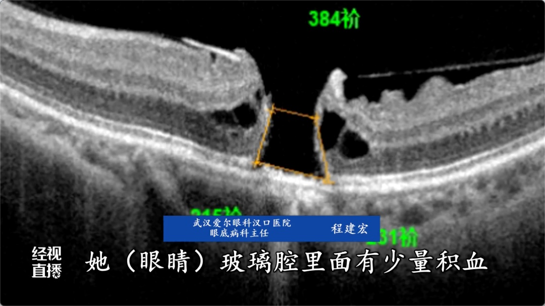 使用时操作不当，女子眼睛“黄斑区灼烧成了一个洞”！很多人夏天爱用，医生紧急提醒