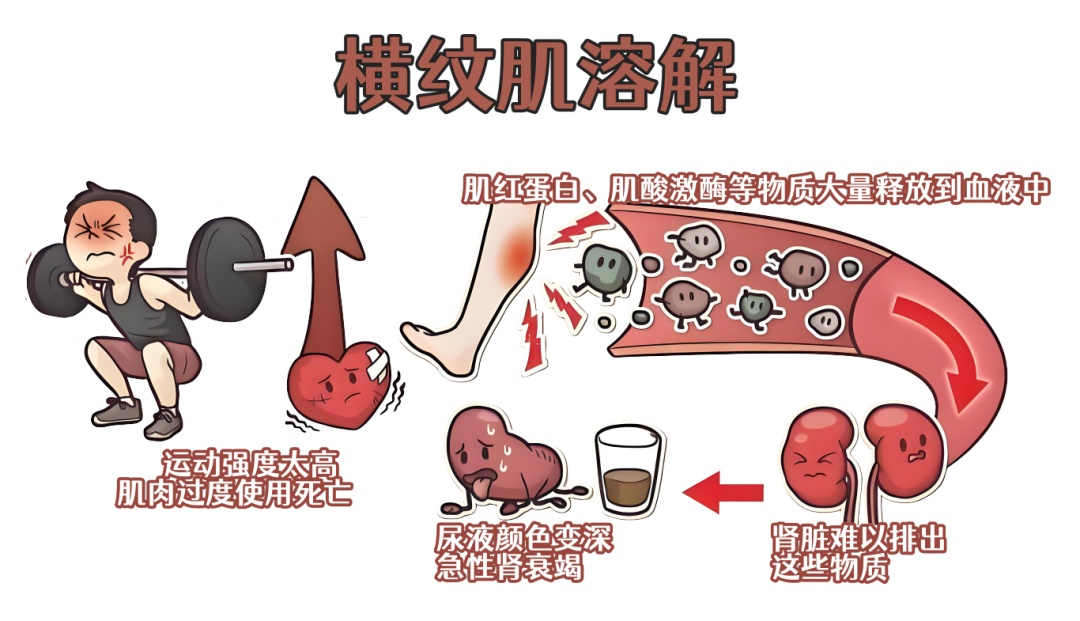 34岁男子尿出“酱油”送医急救，医生：切不可硬抗