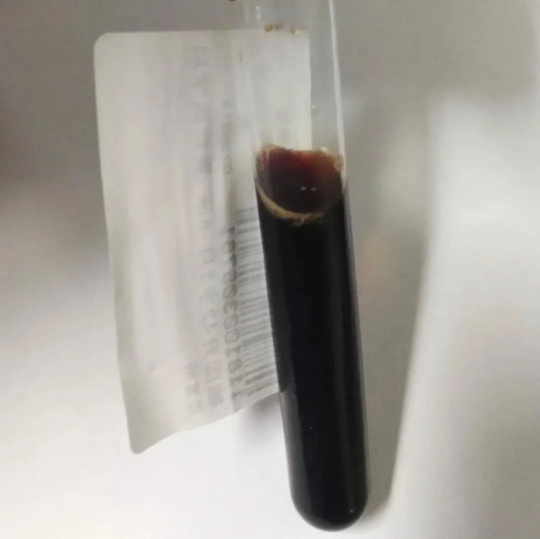 34岁男子尿出“酱油”送医急救，医生：切不可硬抗