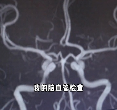 上海三甲医院脑梗专家自曝:确诊脑梗!45岁中招,原因让人心疼,曾高烧抢救病人后倒下 上海三甲医院脑梗专家自曝:确诊脑梗!45岁中招,原因让人心疼,曾高烧抢救病人后倒下