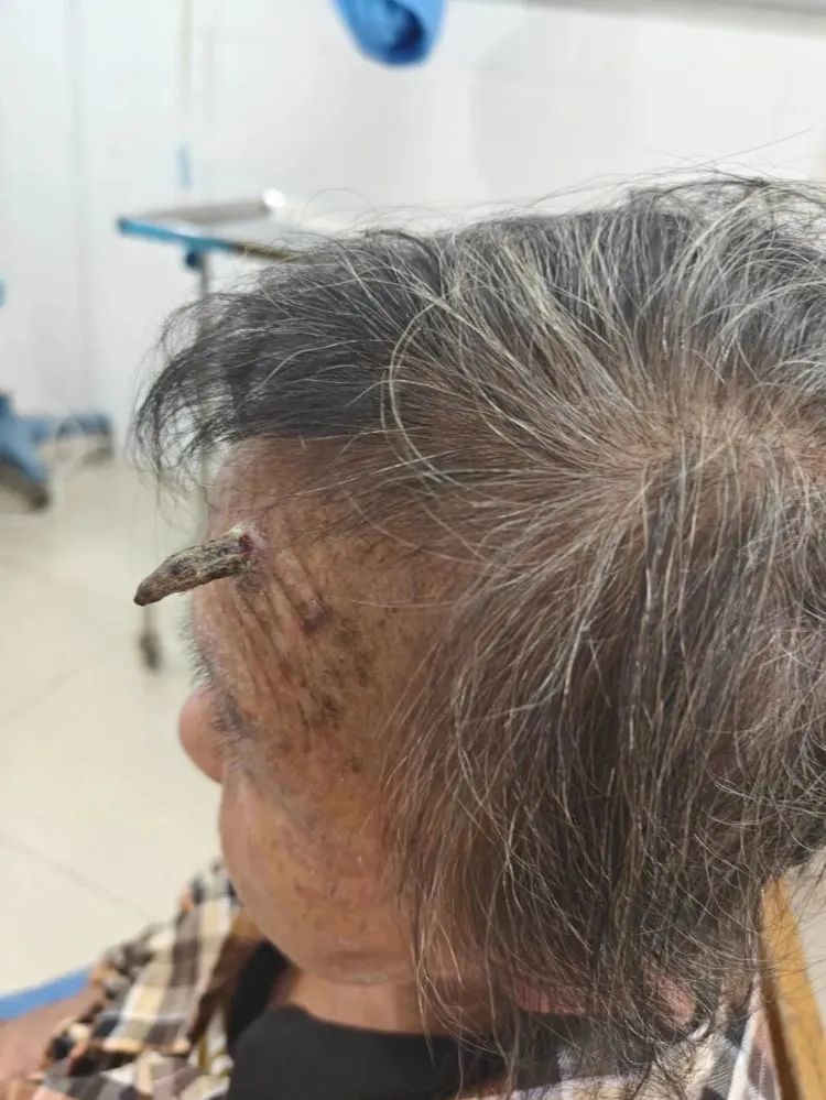 太狠了!98岁老人头上长“角”?一剪刀下去,后果严重!医生也傻眼了…… 太狠了!98岁老人头上长“角”?一剪刀下去,后果严重!医生也傻眼了……