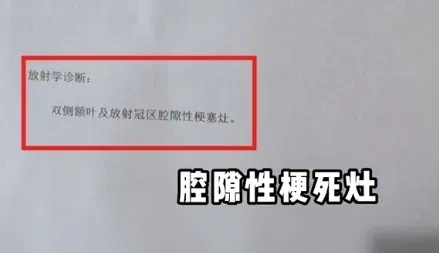 上海三甲医院脑梗专家自己也脑梗了！曾高烧40度做手术！这些高危因素千万警惕