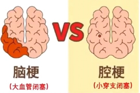 上海三甲医院脑梗专家自曝确诊脑梗!这些高危因素千万警惕 上海三甲医院脑梗专家自曝确诊脑梗!这些高危因素千万警惕