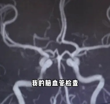 上海三甲医院脑梗专家自己也脑梗了！曾高烧40度做手术！这些高危因素千万警惕