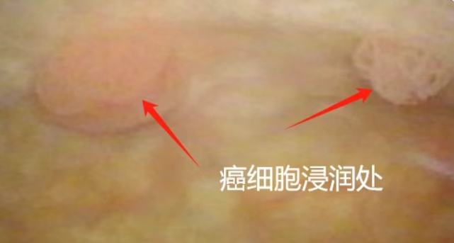 不痛不痒一查竟是癌？这5种“悄无声息”的癌症，很多发现已是晚期