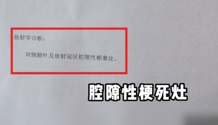 上海三甲医院脑梗专家自曝确诊脑梗!这些高危因素千万警惕 上海三甲医院脑梗专家自曝确诊脑梗!这些高危因素千万警惕