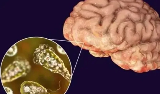 接连两名儿童感染“食脑虫”去世！警惕：病死率极高