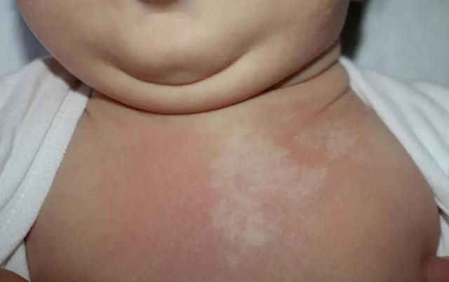 身上突然白了一块，到底是怎么回事？是得了白癜风吗？