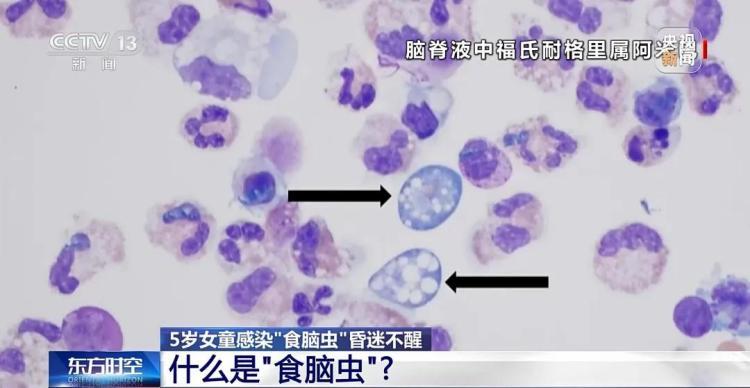 一月两起“食脑虫”夺命悲剧 玩水如何避开致命威胁？