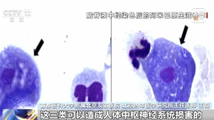 一月两起“食脑虫”夺命悲剧 玩水如何避开致命威胁？