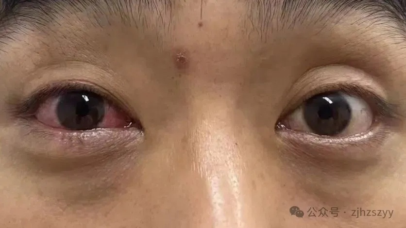 杭州男子爬山遇五步蛇，“难得一见”想抓来玩，毒液直接喷进眼睛