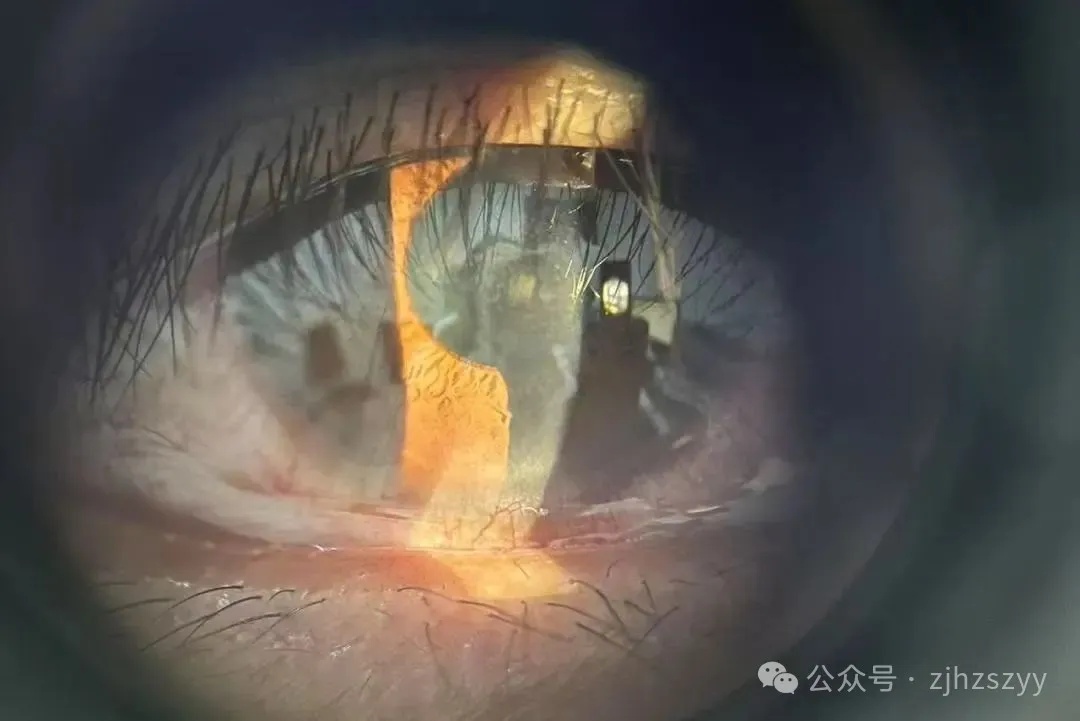 杭州男子爬山遇五步蛇，“难得一见”想抓来玩，毒液直接喷进眼睛