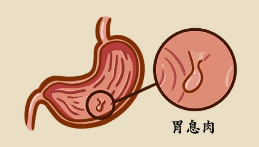 30岁李雪琴自曝：癌症筛查指标异常高，胃部切除8个息肉