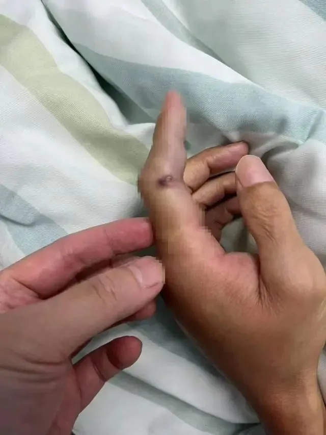 6岁男童沙滩光脚踩到死鱼，第二天高烧晕倒进了ICU！原因是它……