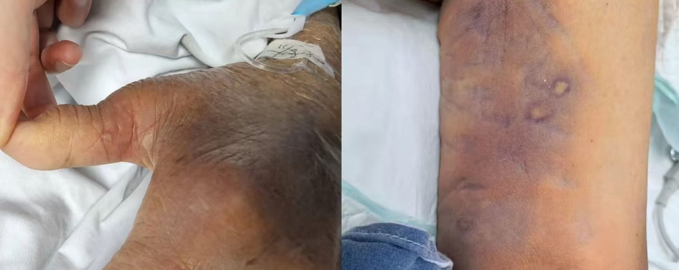 八旬老人被蛰100多下后不幸身亡！已进入高发期，紧急提醒