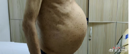 正常人脾脏不到1斤 这个巨脾长到近24斤 南昌这位患者平时忽视的症状要注意