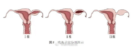 半个子宫怀双胎？！极高危产妇顺利剖宫产