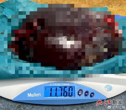 正常人脾脏不到1斤 这个巨脾长到近24斤 南昌这位患者平时忽视的症状要注意