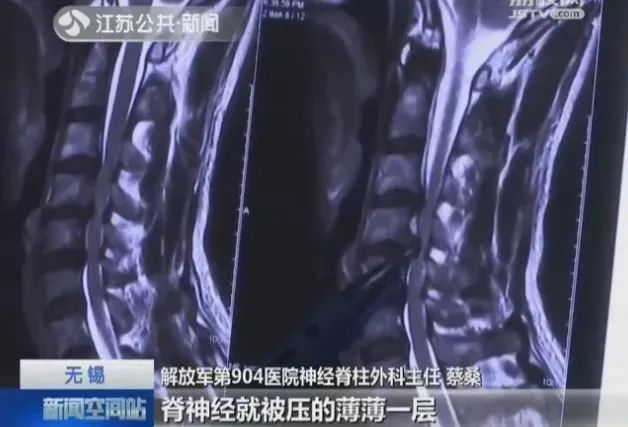 19岁小伙突然高位瘫痪?医生紧急提醒:这个常见动作害了很多人!快自查 19岁小伙突然高位瘫痪?医生紧急提醒:这个常见动作害了很多人!快自查