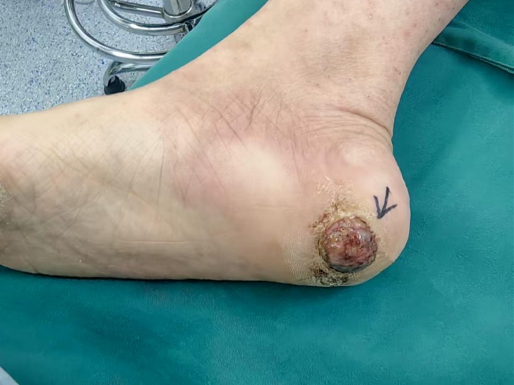 女子脚被扎伤后，竟长出“癌中之王”！医生紧急提醒