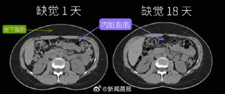 注意！缺觉，可能会让你加速变胖