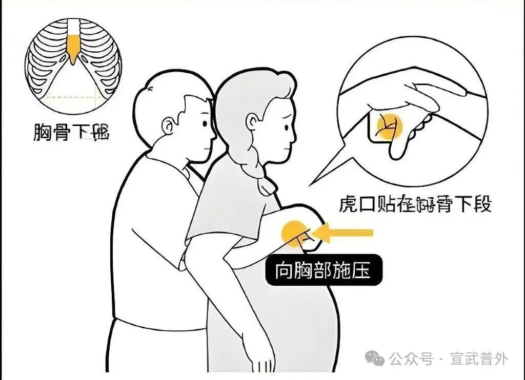 一招“顶”命,必学海姆立克! 一招“顶”命,必学海姆立克!