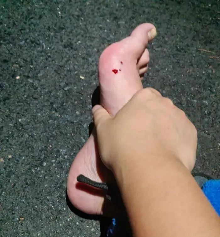 毒蛇咬伤！夜爬合肥大蜀山的要注意了