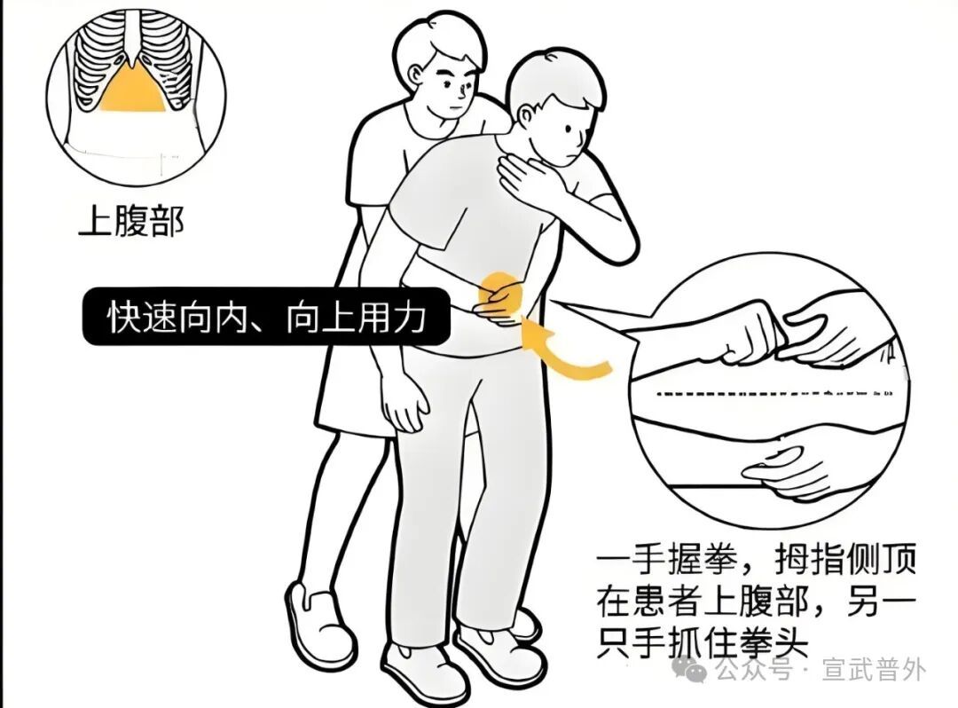 一招“顶”命,必学海姆立克! 一招“顶”命,必学海姆立克!