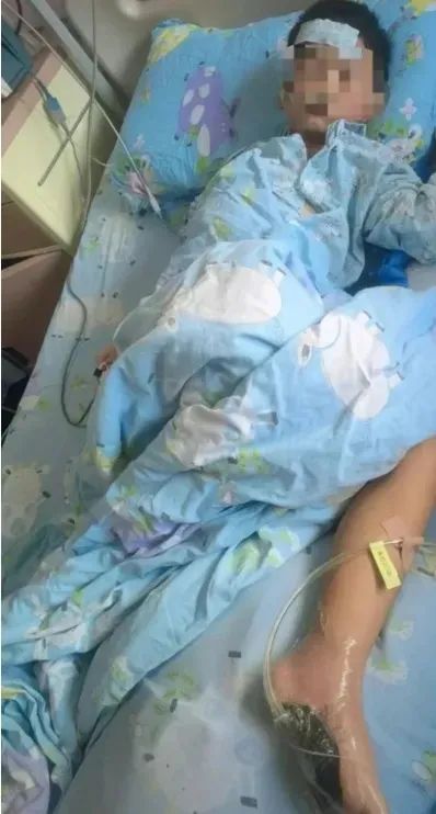 这种细菌一旦感染可能要截肢！赶海、吃海鲜都要注意！